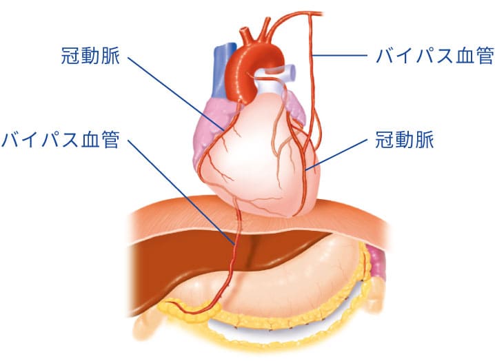 冠動脈バイパスの図