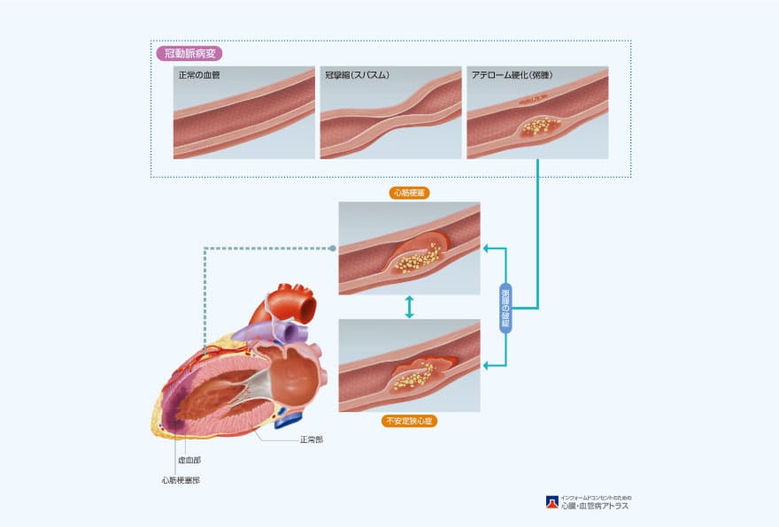 冠動脈疾患の図
