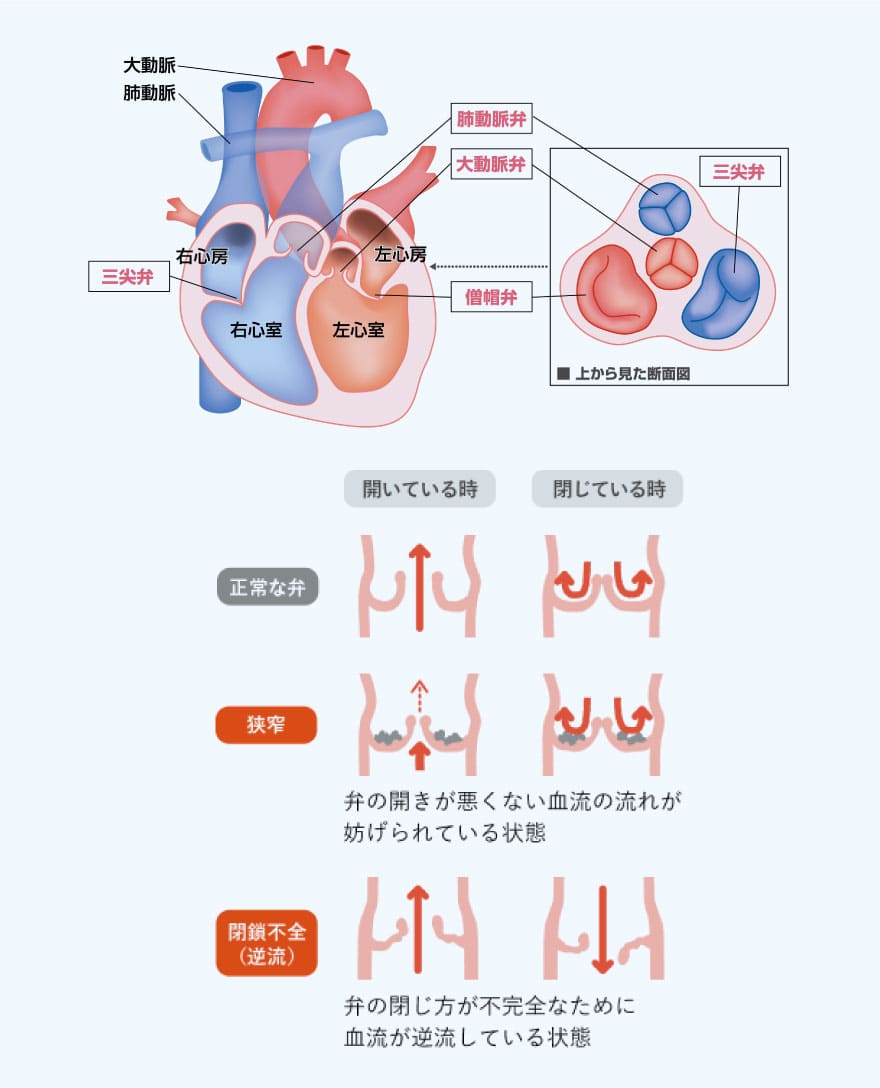 心臓弁膜症の図