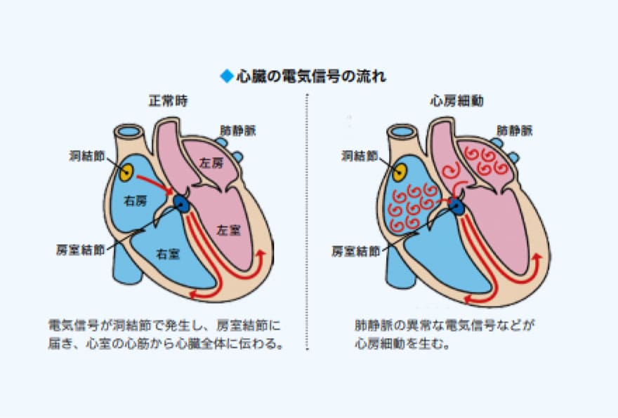 不整脈の図