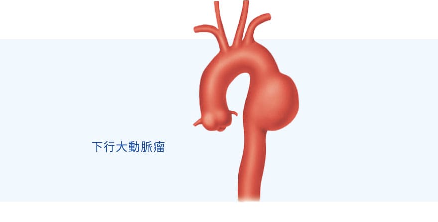 大動脈瘤の図