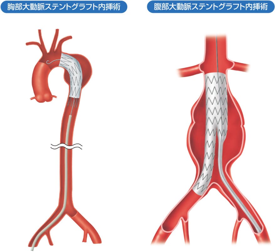 ステントグラフト内挿術の図