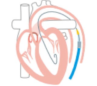 経大腿からのTAVIの留置方法の説明図①