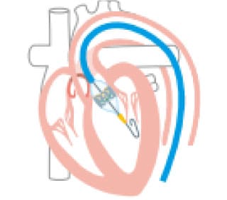 経大腿からのTAVIの留置方法の説明図②