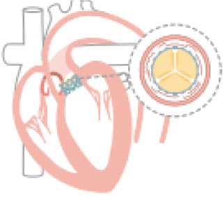 経大腿からのTAVIの留置方法の説明図④