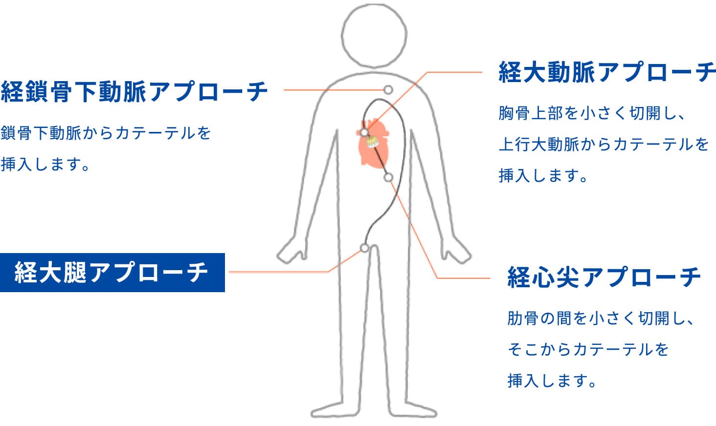 心臓までのアプローチ方法の図 経鎖骨下動脈アプローチ…鎖骨下動脈からカテーテルを挿入します。 経大動脈アプローチ…胸骨上部を小さく切開し、上行大動脈からカテーテルを挿入します。 経心尖アプローチ…肋骨の間を小さく切開し、そこからカテーテルを挿入します。 経大腿アプローチ