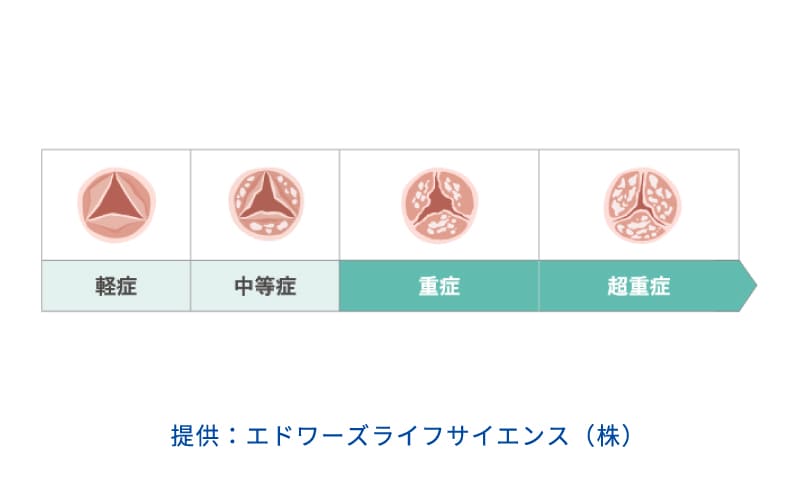 大動脈の状態の図