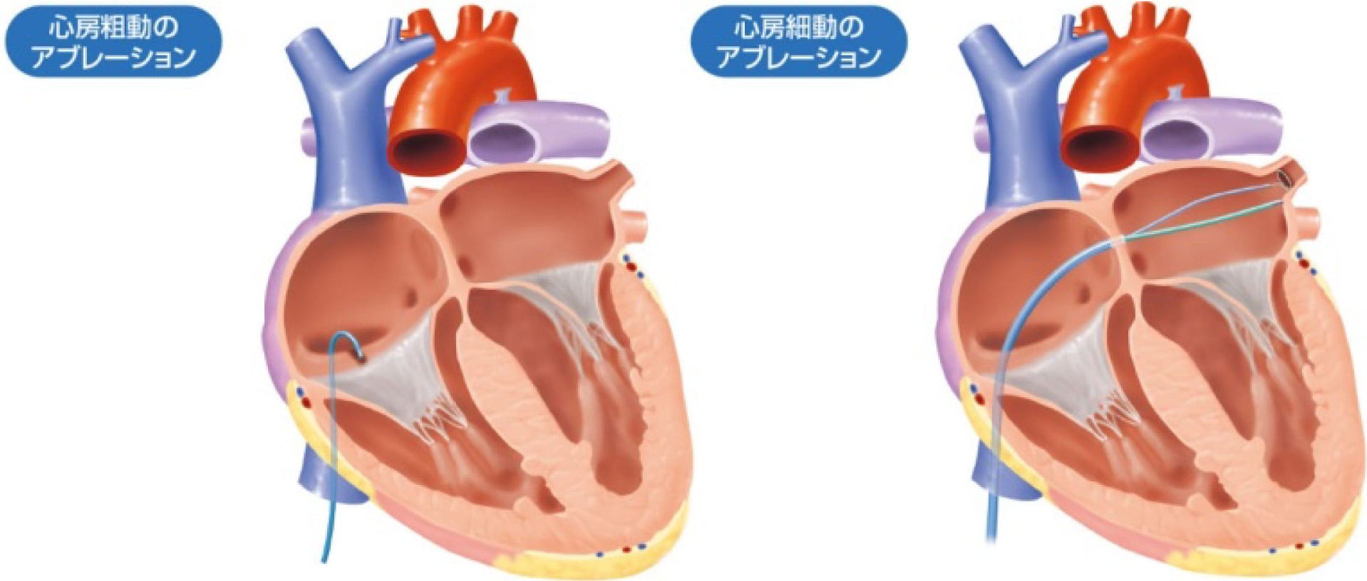 アブレーションの図②