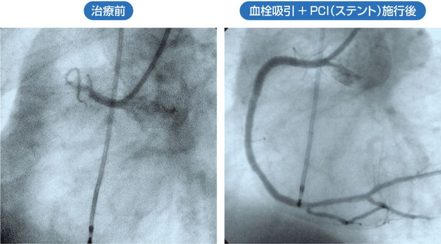 経皮的冠動脈形成術（PCI）施工後と施工前の比較図