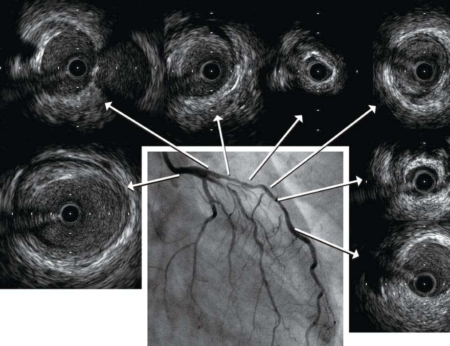 IVUS（血管内超音波検査）の図