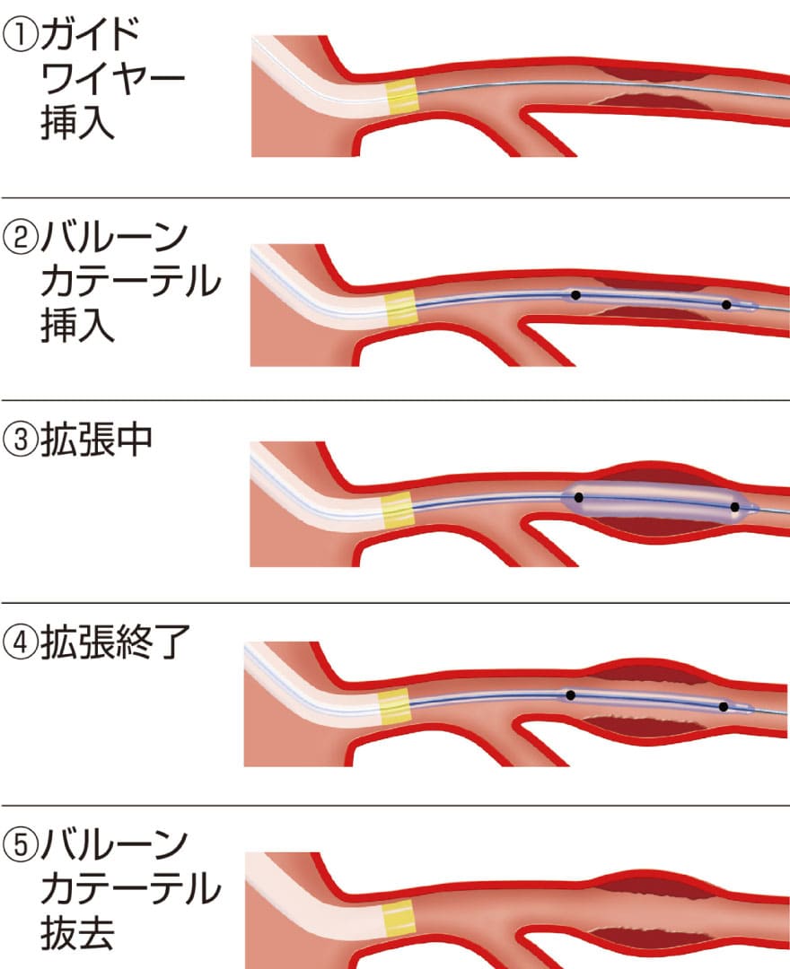 バルーン療法