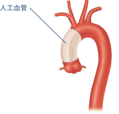 人工血管置換術