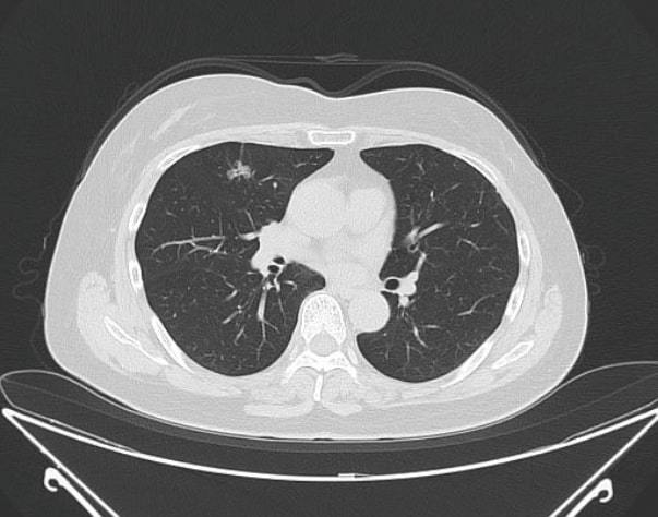 低線量胸部CT写真