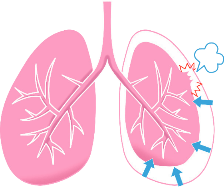 気胸の参考画像