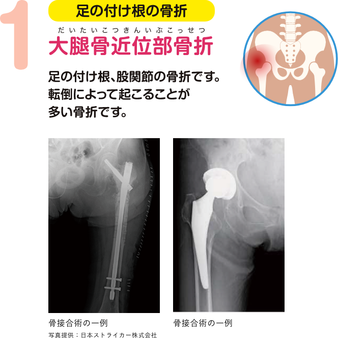 足の付け根の骨折 大腿骨近位部骨折