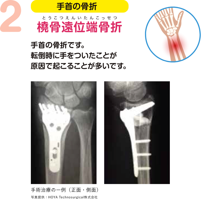 手首の骨折 橈骨遠位端骨折