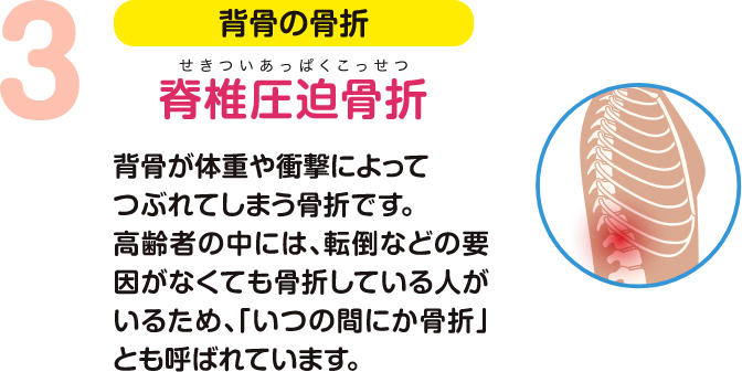 背骨の骨折 脊椎圧迫骨折