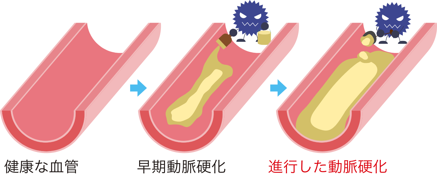 健康な血管と早期動脈硬化と進行した動脈硬化を比較した図