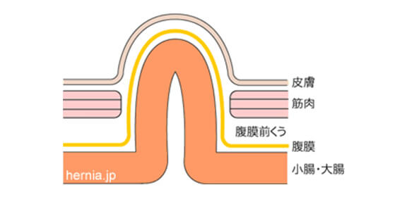 そけいヘルニアの病態