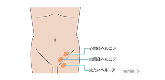 そけいヘルニアの3つのタイプ