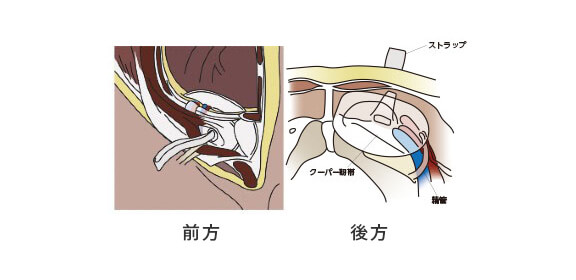 ダイレクト・クーゲル法