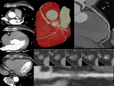 心臓(冠動脈)CT