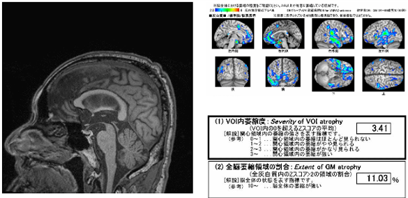 認知症検査(VSRAD)