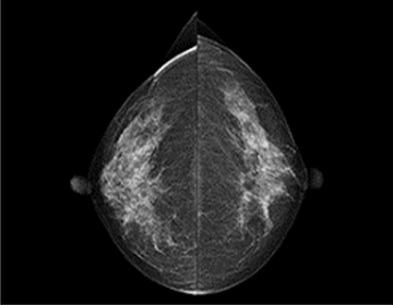 マンモグラフィ検査