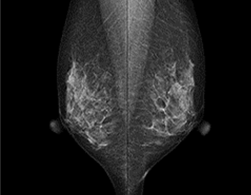 マンモグラフィ検査